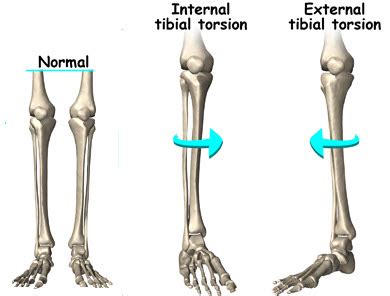 tibial torsion in adults